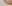 涙袋ヒアルロン酸注入（涙袋形成） — フルルン美容外科クリニック