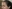 lower blepharoplasty (under-eye bag removal with fat repositioning) — Leaf Plastic Surgery Clinic