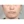 ผ่าตัดลดโหนกแก้มแบบเร็ว (ไม่ใส่ตัวยึด) — ก่อนทำ (90วัน) · ID Hospital - โรงพยาบาลหลัก