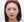 Paranasal (nasal base) augmentation with implant — after (50days) · iLumi Plastic Surgery Clinic