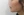 ตัดไขมันกระพุ้งแก้ม — หลังทำ (9วัน) · ไอรูมิ ศัลยกรรมพลาสติก