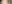 buried suture (non-incisional) double eyelid surgery — DM Plastic Surgery Clinic