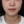 Ultraformer MPT (อัลตร้าฟอร์เมอร์ เอ็มพีที) — หลังทำ · คลินิกรีไฟน์