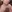 Double chin liposuction (submental liposuction) — Uri Plastic Surgery Clinic
