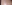 額（おでこ）の脂肪注入 — シャープ美容外科クリニック