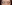 裏ハムラ法（経結膜的眼窩脂肪移動術） — プレジャー美容外科クリニック