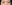 Lower Eyelid Fat Repositioning (transconjunctival) — Pleasure Plastic Surgery Clinic