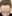 Masseter Botox (jaw slimming / square jaw reduction) — Uline Clinic