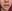 Lip lift (philtrum reduction) — Ua Plastic Surgery Clinic
