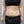 Back lipolysis injection (fat-dissolving injection) — before (14days) · Pladen Plastic Surgery Clinic