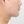 Platysma plication (corset platysmaplasty for double chin/jawline) — after (7days) · AB Plastic Surgery & Skin Clinic