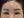 内視鏡下額（前額）リフト（エンドタイン固定） — 術後 (13日) · ザ・オーリム美容外科クリニック