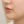 ฟิลเลอร์ใต้ตา (แก้ร่องใต้ตา / ขอบตาคล้ำ) — หลังทำ · คลินิกเสริมความงาม ด็อกเตอร์เซม