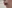 Lip filler (lip augmentation with HA) — Cha Min Plastic Surgery Clinic