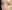 revision eyelid surgery (secondary blepharoplasty) — Luho Plastic Surgery Clinic