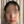 Ultracol (PDO microsphere collagen stimulator injection) — before (2days) · Project U Clinic