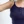 Brachioplasty (arm lift) — after (60days) · Cheongdam OK Plastic Surgery Clinic