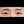 Aegyo-sal filler (under-eye 'love band' / pretarsal roll filler) — after · Pixel Lab Plastic Surgery Clinic