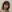 眼瞼下垂手術（目つき矯正） — ID病院-本院