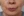 JUVGEN (autologous dermal regeneration / collagen-induction injection) — before (14days) · Saeroun Plastic Surgery
