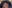 額縮小術（生え際下げ・ヘアライン下降術） — ザフィックス美容外科クリニック