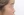 Short nose correction (nose lengthening / derotation) — before (14days) · iLumi Plastic Surgery Clinic