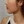 สลายไขมันใบหน้าด้วยเลเซอร์ (AccuSculpt) — ก่อนทำ (3วัน) · เออร์เน่คลินิก