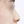 Nasal osteotomy (nasal bone narrowing) — before (7days) · Pop Plastic Surgery Clinic