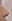 Nasal Tip Plasty with Autologous Cartilage — Litmus Plastic Surgery
