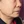 Full-face filler (full-face HA rejuvenation) — after · Project U Clinic