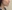 Chin reduction (chin bone shaving / narrowing genioplasty) — Uri Plastic Surgery Clinic