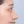 Nasal tip augmentation with donor (acellular) dermal matrix — after (16days) · Thank You Plastic Surgery