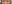 裏ハムラ法（経結膜的眼窩脂肪移動術） — プレジャー美容外科クリニック