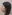 鼻尖形成術（自家軟骨移植） — ウィバース美容外科クリニック