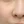 Laser Genesis (Cutera; long-pulsed 1064 nm Nd:YAG non-ablative rejuvenation) — after (28days) · J.Fill Clinic - Gangnam Branch