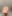 二の腕の脂肪吸引 — ヒューゴ美容外科クリニック
