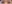 提眼瞼肌手術（眼型矯正） — View醫美診所