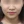 TuneLiner (non-invasive ultrasound fat reduction & contouring) — after (28days) · J.Fill Clinic - Gangnam Branch