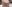 Breast augmentation with implants — The Body Plastic Surgery Clinic