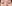 裏ハムラ法（経結膜的眼窩脂肪移動術） — エイペックス美容外科クリニック