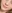 Lip filler (lip augmentation with HA) — Cheongdam FNB Clinic