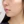 Volnewmer (โวลนิวเมอร์ ยกกระชับด้วย RF) — ก่อนทำ (14วัน) · เอท็อปคลินิกศัลยกรรมพลาสติก
