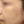 Chemical peel — before (28days) · J.Fill Clinic - Gangnam Branch