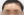 Forehead reduction (hairline lowering surgery) — after (14days) · iLumi Plastic Surgery Clinic
