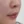 โบท็อกซ์ร่นร่องริมฝีปาก (Lip Flip ทำให้ร่องใต้จมูกดูสั้นลง) — หลังทำ (7วัน) · คลินิก Younme