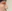 Bulbous nose correction (surgical nasal tip reduction) — Another Plastic Surgery Clinic