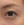 Eyelid filler (upper eyelid hollowing correction) — after (14days) · Wow Plastic Surgery