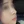Nose tip filler — after · Erne Clinic