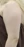 Arm liposuction — before (7days) · Seoul During Clinic