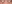 裏ハムラ法（経結膜的眼窩脂肪移動術） — プレジャー美容外科クリニック